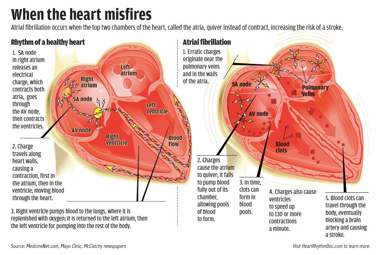 When the heart misfires